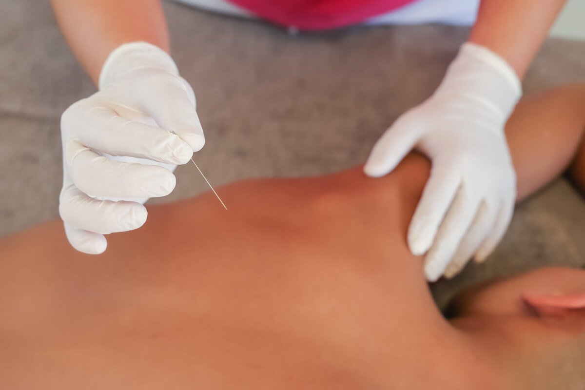 Dry needling kentro fisiotherapias therafit sto ilion kai petroupoli