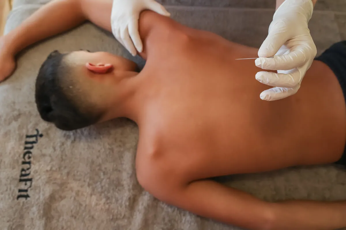Dry needling